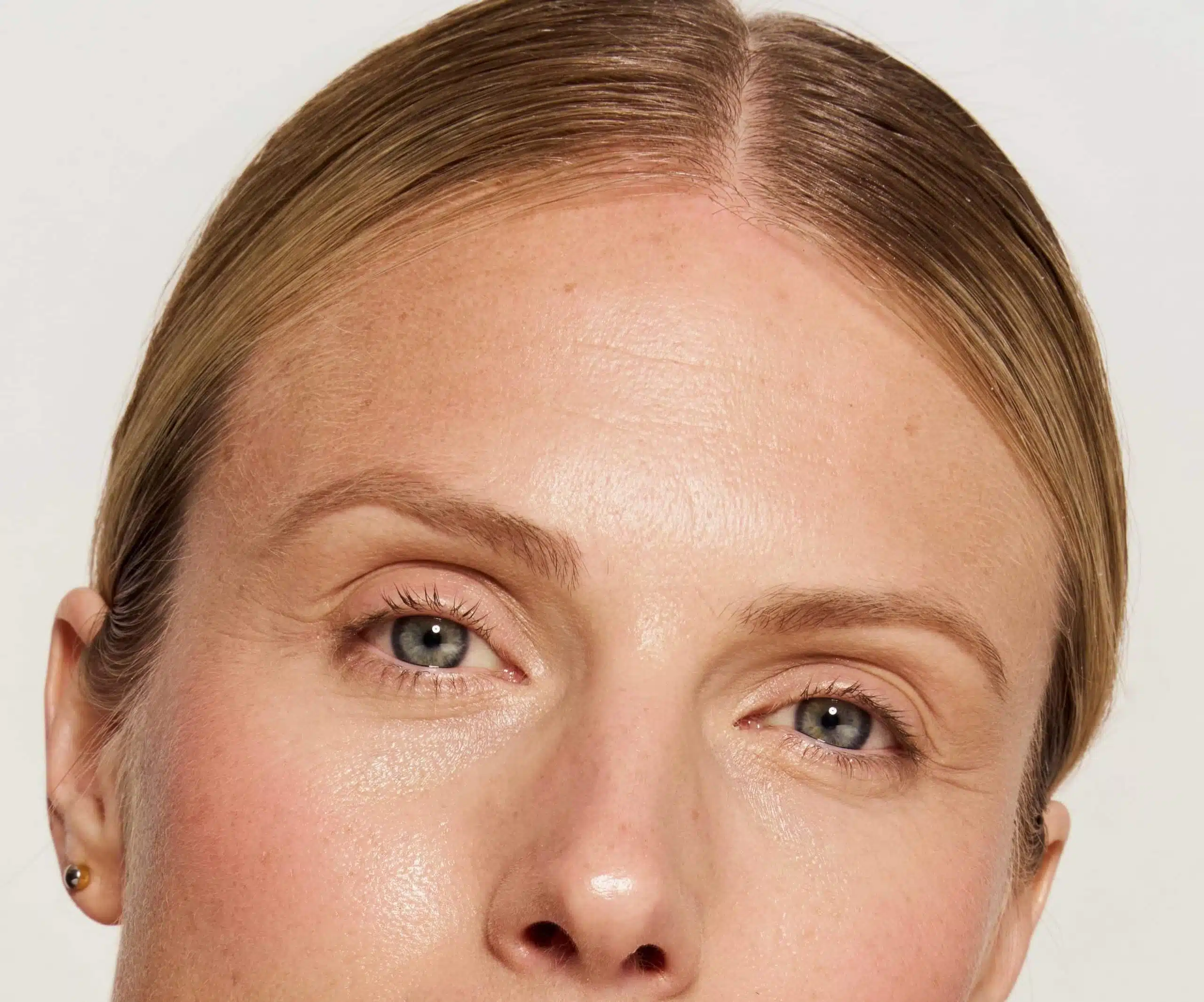 Zornesfalten behandeln