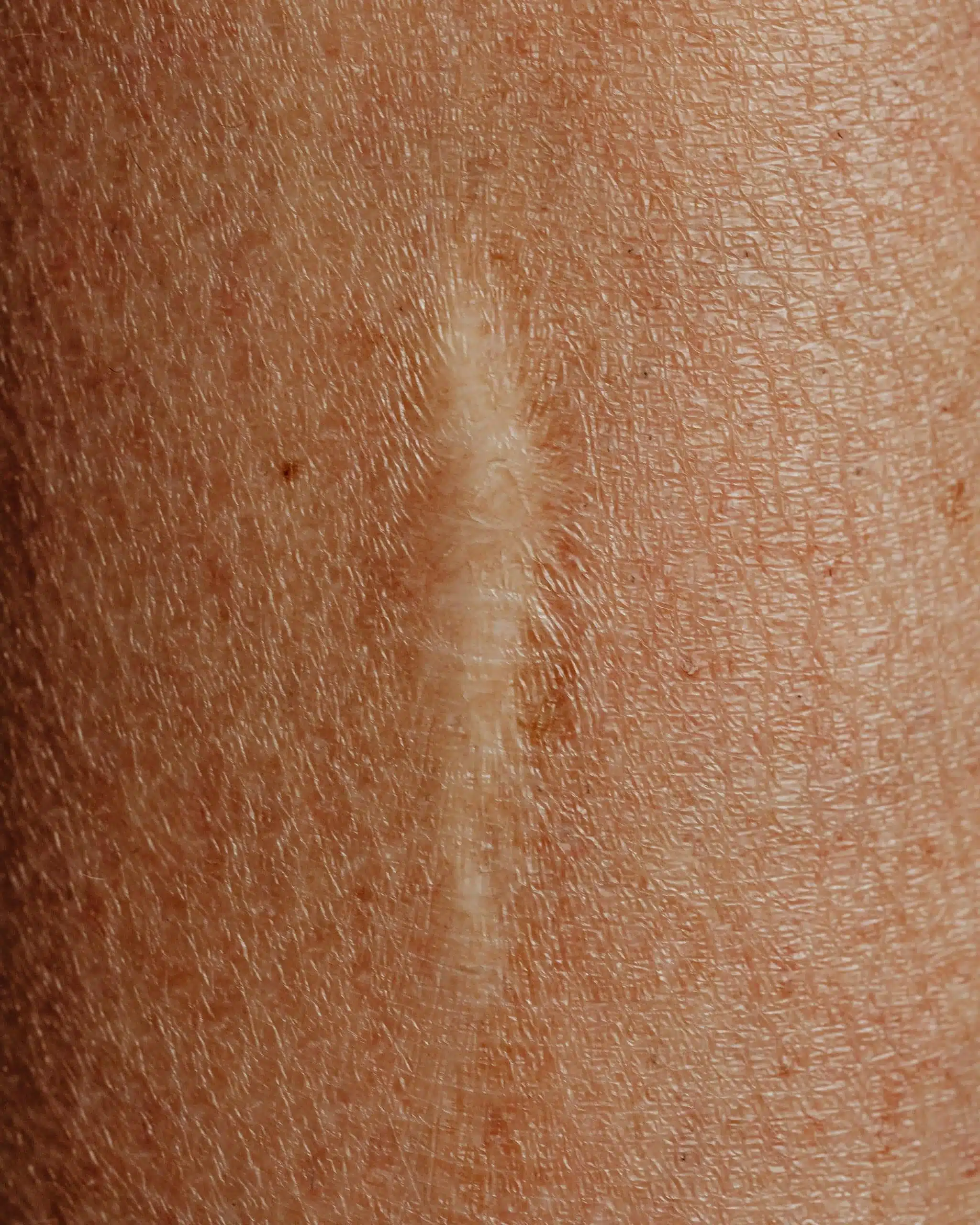 Gefäßlaser Nd:YAG Behandlung